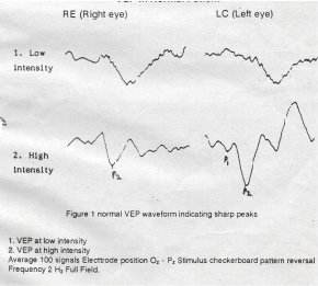 Figure 3 VEP in Normal